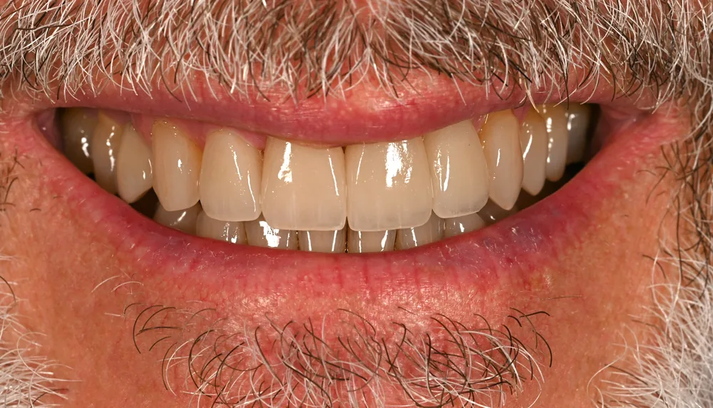 After smile transformation with porcelain restorations, case 1 — Tillinger Dental, Miami Beach
