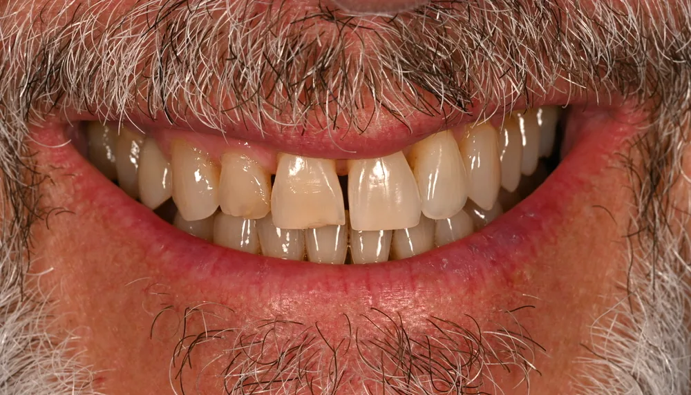 Before smile transformation, case 1 — Tillinger Dental, Miami Beach