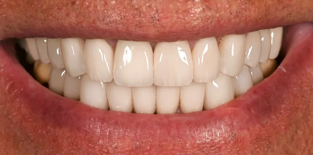 After smile transformation with porcelain restorations, case 3 — Tillinger Dental, Miami Beach