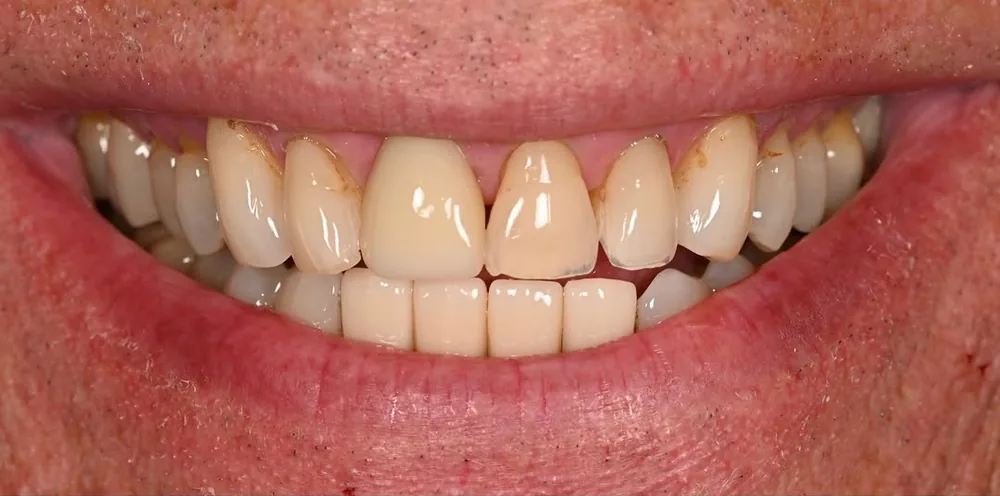 Before smile transformation, case 3 — Tillinger Dental, Miami Beach
