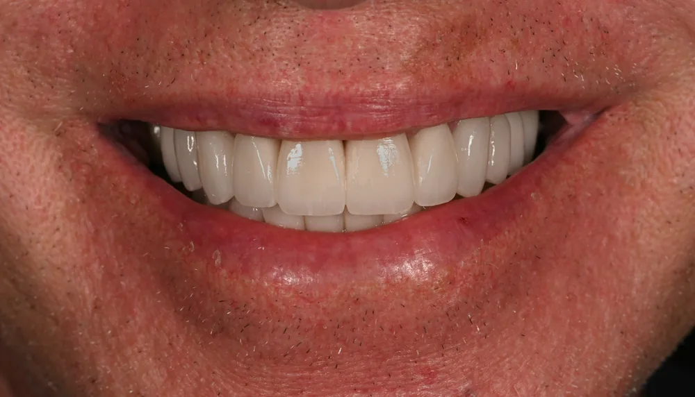 After smile transformation with porcelain restorations, case 4 — Tillinger Dental, Miami Beach