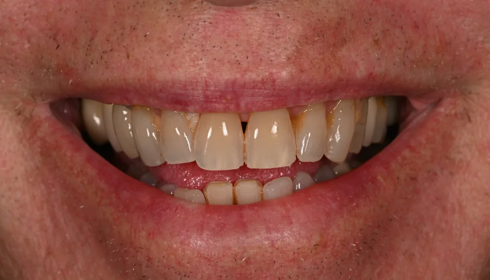 Before smile transformation, case 4 — Tillinger Dental, Miami Beach