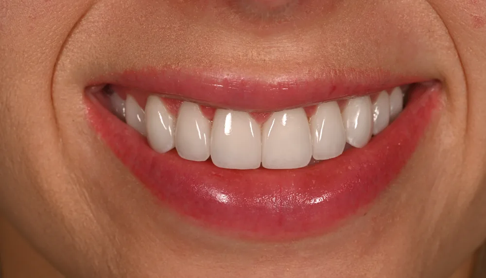 After smile transformation with porcelain restorations, case 5 — Tillinger Dental, Miami Beach