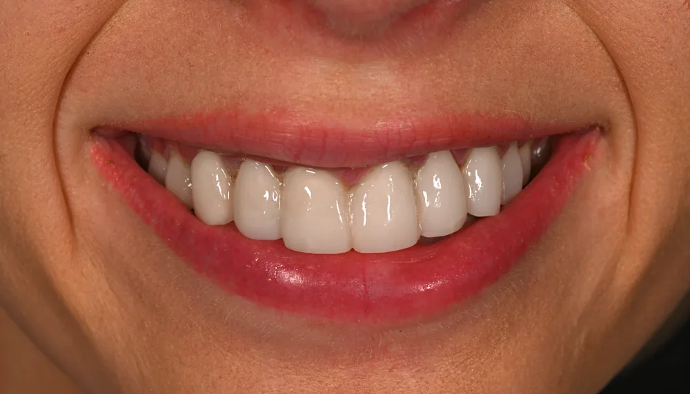 Before smile transformation, case 5 — Tillinger Dental, Miami Beach