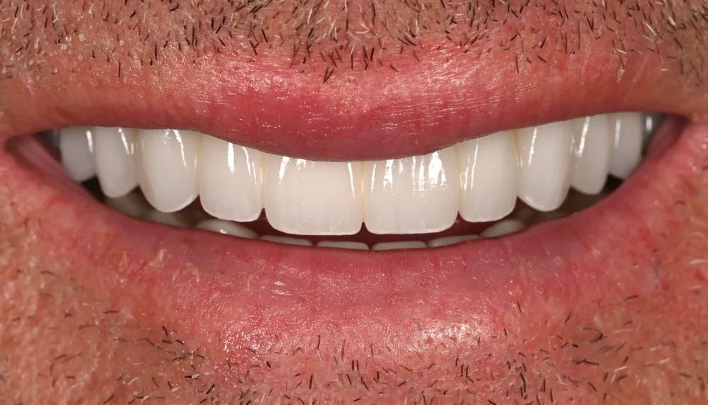 After smile transformation with porcelain restorations, case 6 — Tillinger Dental, Miami Beach