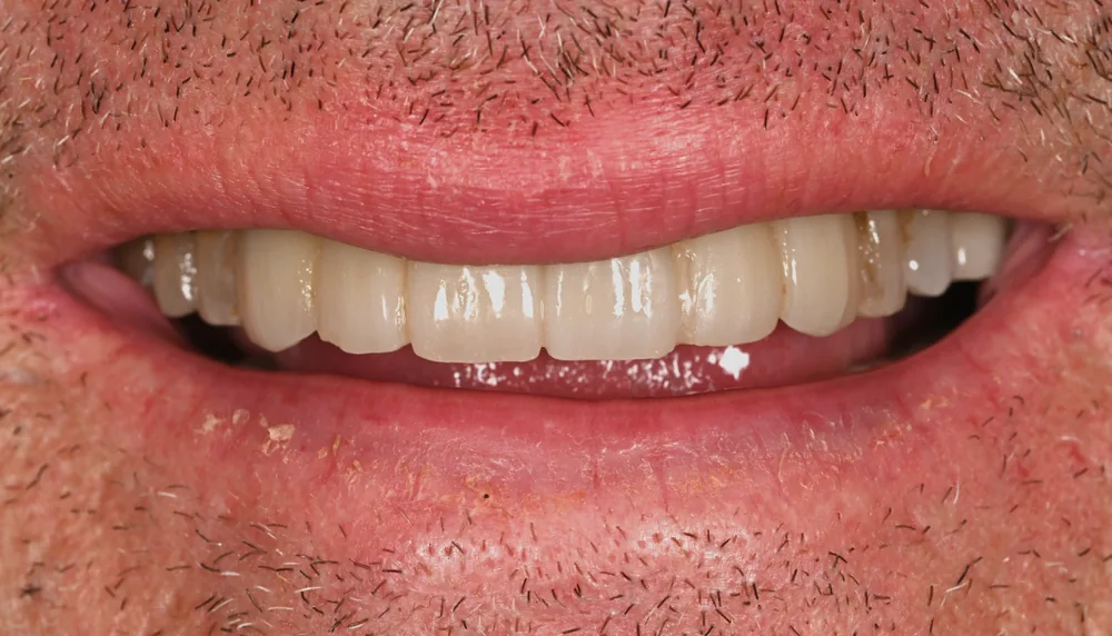 Before smile transformation, case 6 — Tillinger Dental, Miami Beach