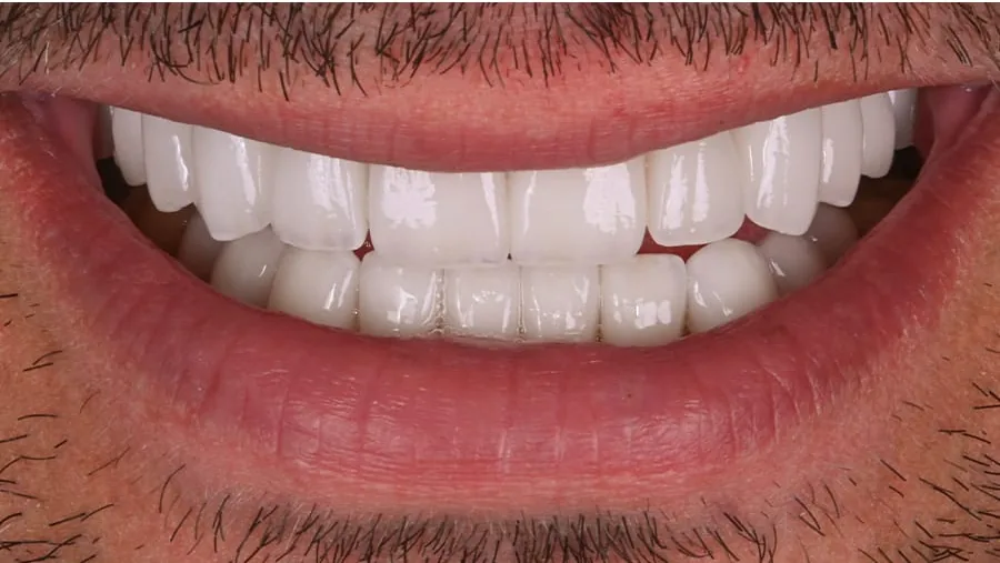 After smile transformation with porcelain restorations, case 7 — Tillinger Dental, Miami Beach
