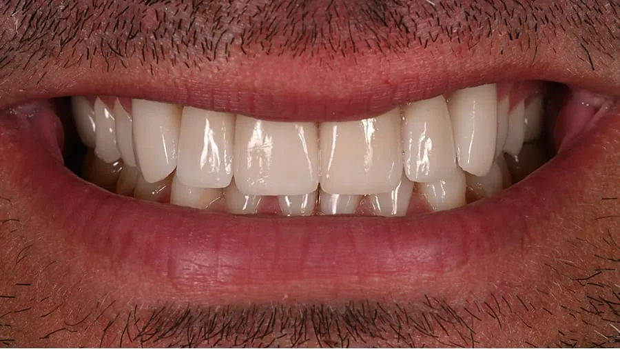 Before smile transformation, case 7 — Tillinger Dental, Miami Beach