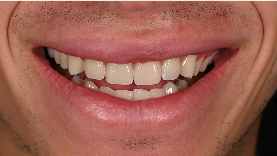 After smile transformation with porcelain restorations, case 8 — Tillinger Dental, Miami Beach