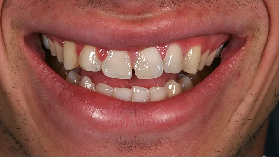 Before smile transformation, case 8 — Tillinger Dental, Miami Beach
