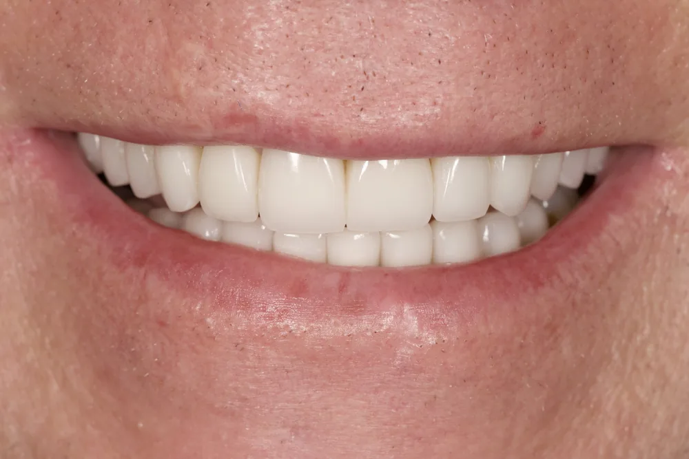 After smile transformation with porcelain restorations, case 10 — Tillinger Dental, Miami Beach