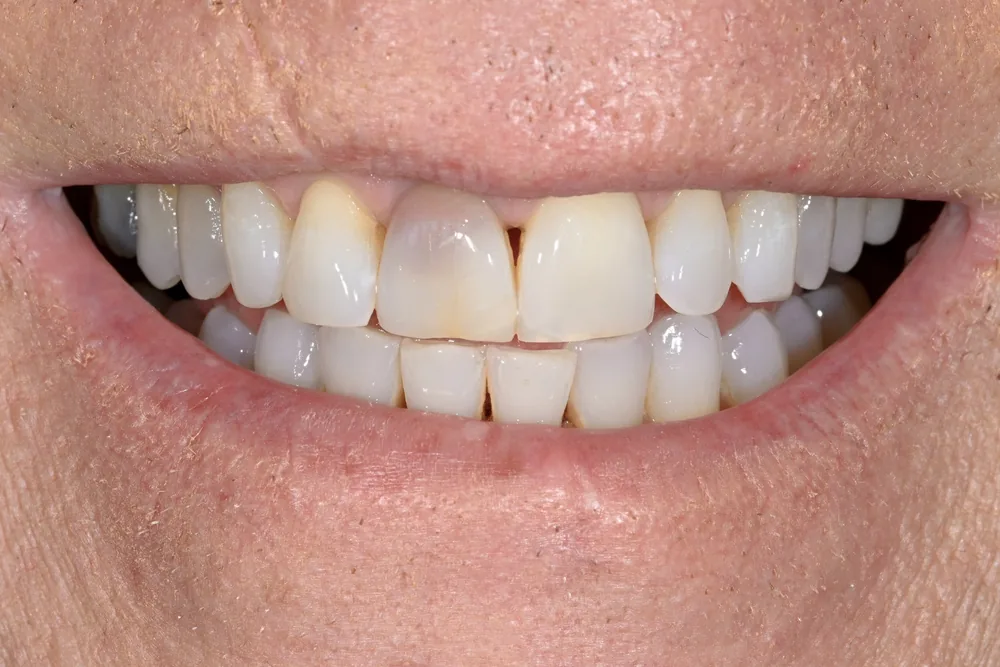 Before smile transformation, case 10 — Tillinger Dental, Miami Beach