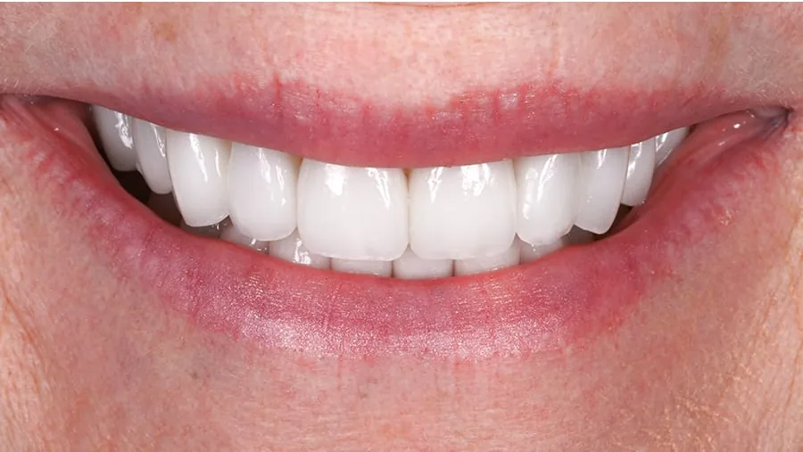 After smile transformation with porcelain restorations, case 11 — Tillinger Dental, Miami Beach