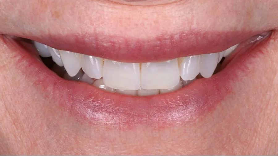 Before smile transformation, case 11 — Tillinger Dental, Miami Beach