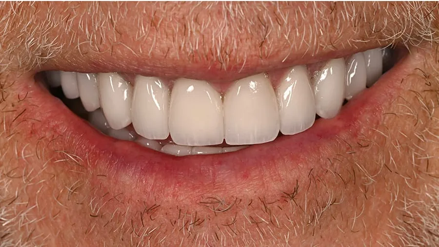After smile transformation with porcelain restorations, case 12 — Tillinger Dental, Miami Beach