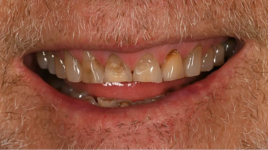 Before smile transformation, case 12 — Tillinger Dental, Miami Beach