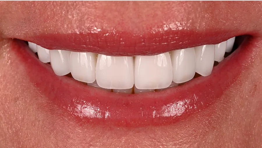 After smile transformation with porcelain restorations, case 13 — Tillinger Dental, Miami Beach