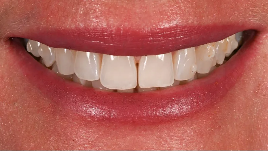 Before smile transformation, case 13 — Tillinger Dental, Miami Beach