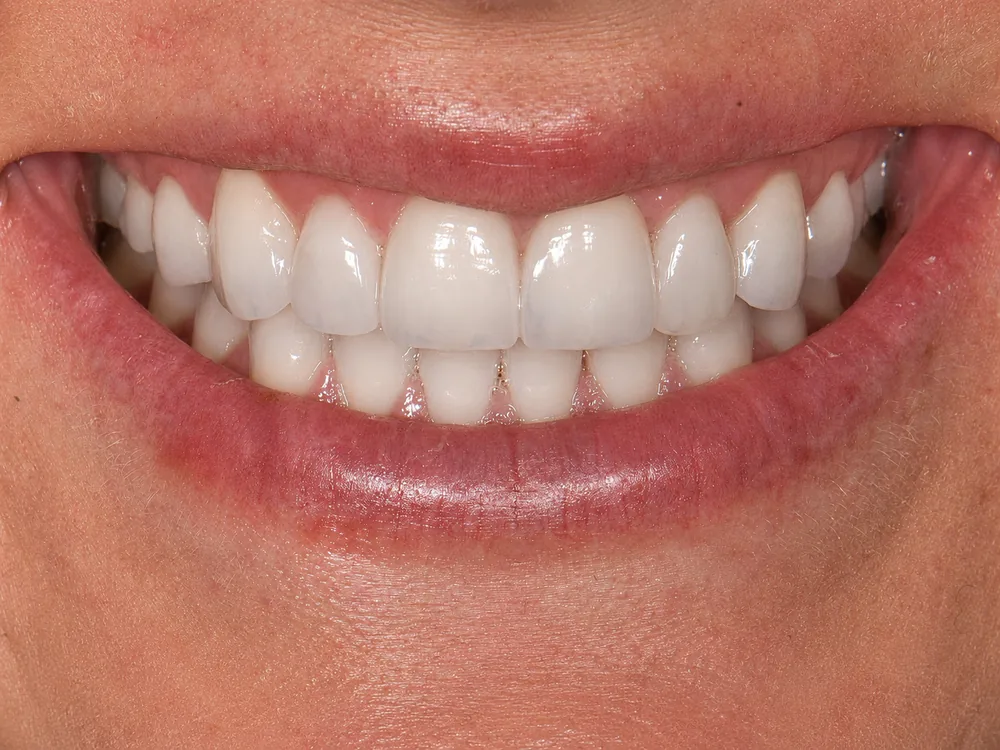 After smile transformation with porcelain restorations, case 14 — Tillinger Dental, Miami Beach