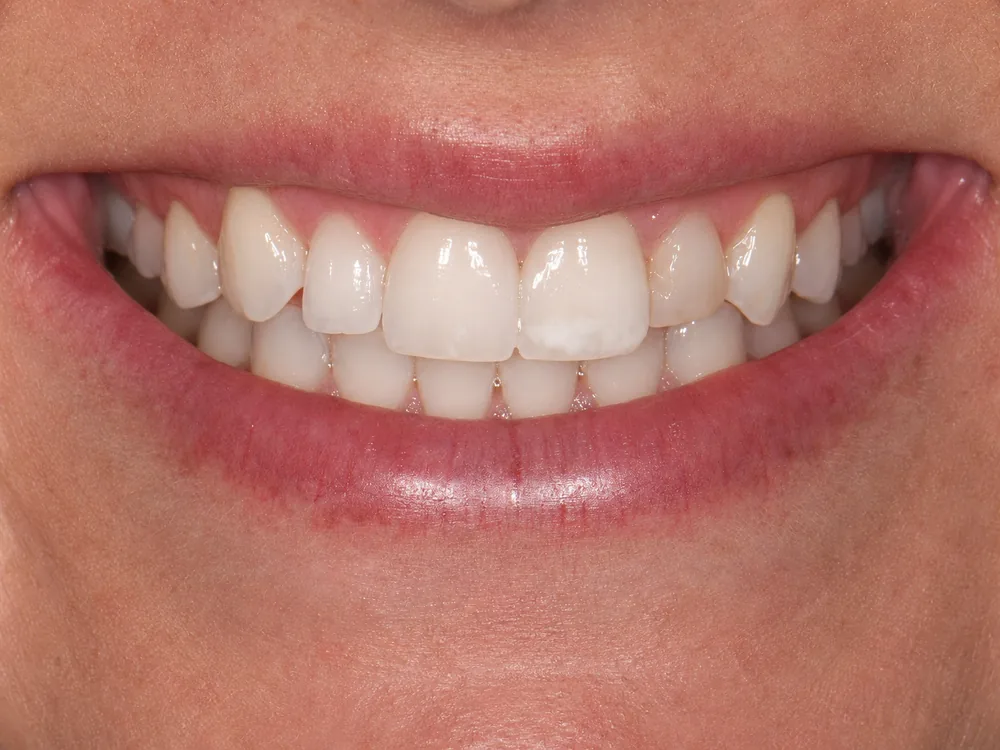 Before smile transformation, case 14 — Tillinger Dental, Miami Beach