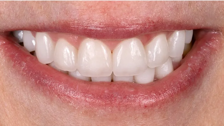After smile transformation with porcelain restorations, case 15 — Tillinger Dental, Miami Beach