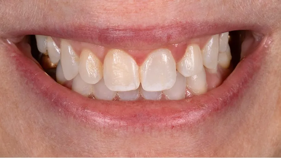 Before smile transformation, case 15 — Tillinger Dental, Miami Beach