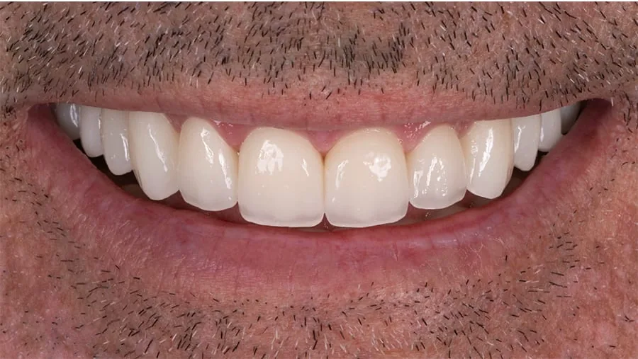 After smile transformation with porcelain restorations, case 16 — Tillinger Dental, Miami Beach