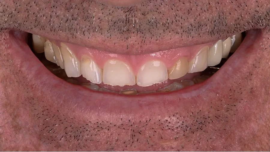 Before smile transformation, case 16 — Tillinger Dental, Miami Beach