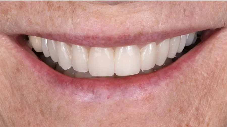 After smile transformation with porcelain restorations, case 17 — Tillinger Dental, Miami Beach