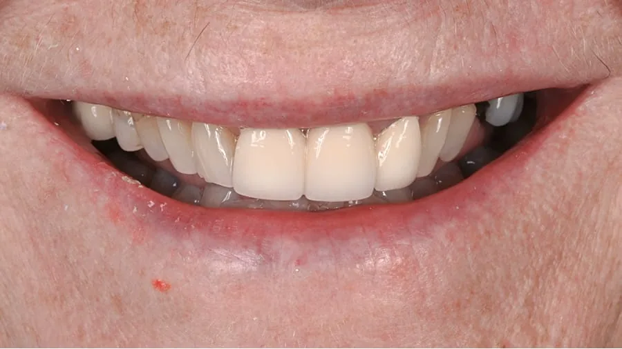 Before smile transformation, case 17 — Tillinger Dental, Miami Beach