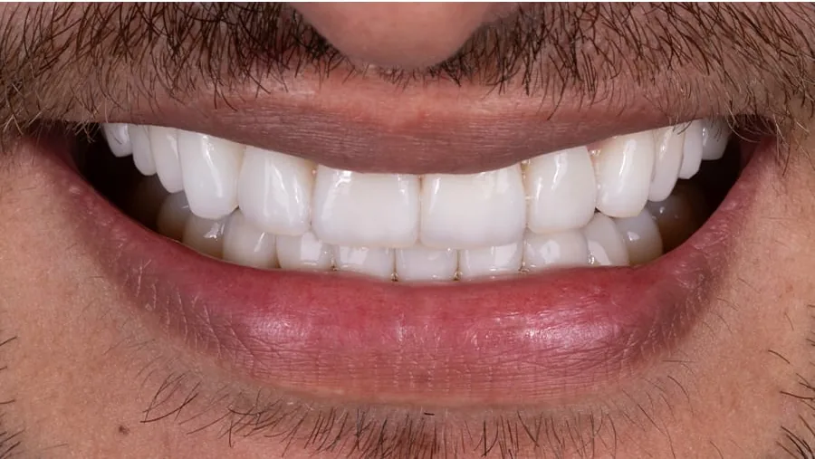 After smile transformation with porcelain restorations, case 18 — Tillinger Dental, Miami Beach
