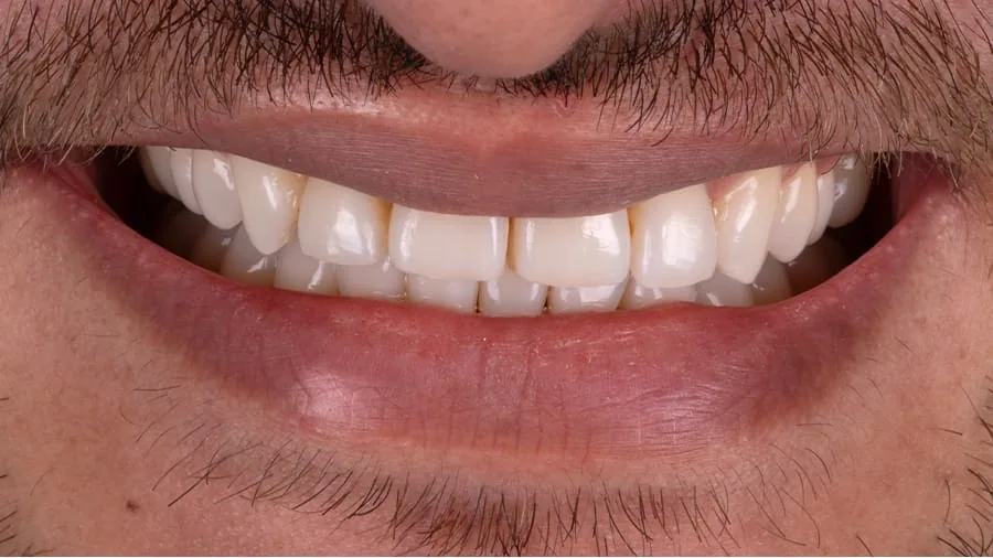 Before smile transformation, case 18 — Tillinger Dental, Miami Beach