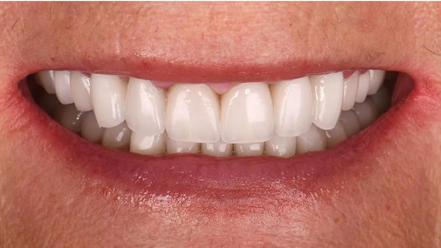 After smile transformation with porcelain restorations, case 21 — Tillinger Dental, Miami Beach