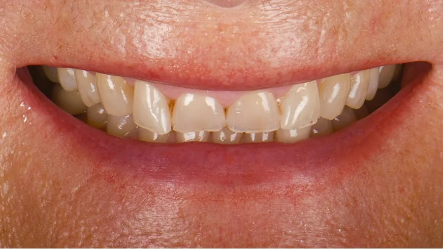Before smile transformation, case 21 — Tillinger Dental, Miami Beach