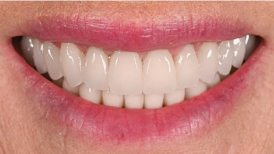 After smile transformation with porcelain restorations, case 22 — Tillinger Dental, Miami Beach