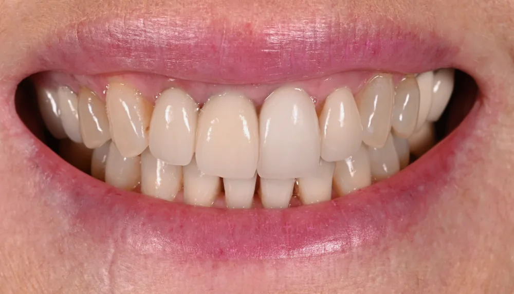 Before smile transformation, case 22 — Tillinger Dental, Miami Beach