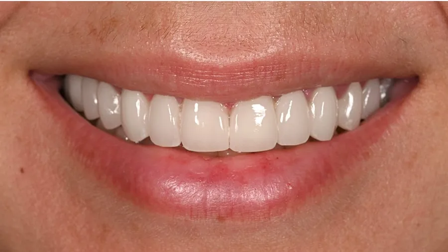 After smile transformation with porcelain restorations, case 23 — Tillinger Dental, Miami Beach