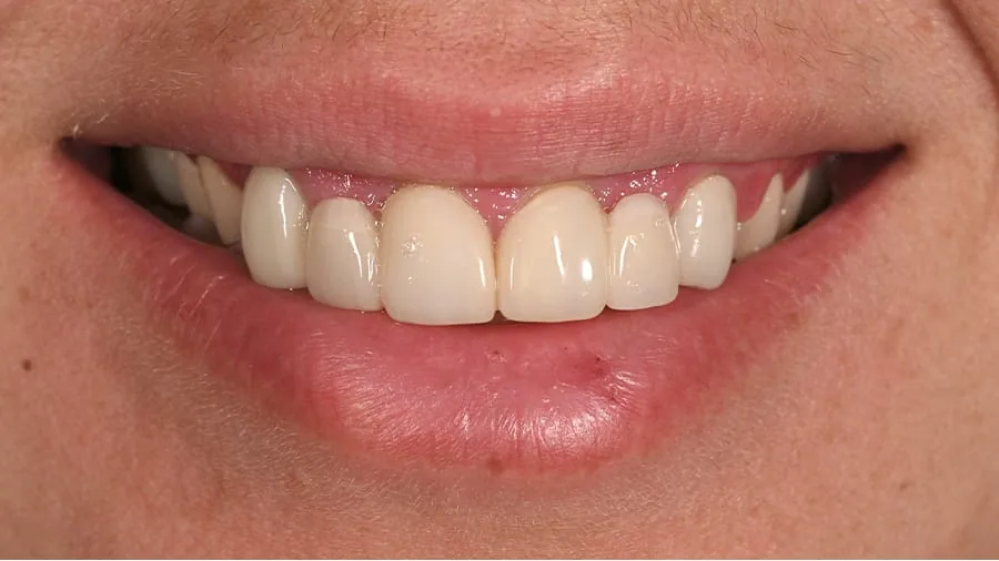 Before smile transformation, case 23 — Tillinger Dental, Miami Beach