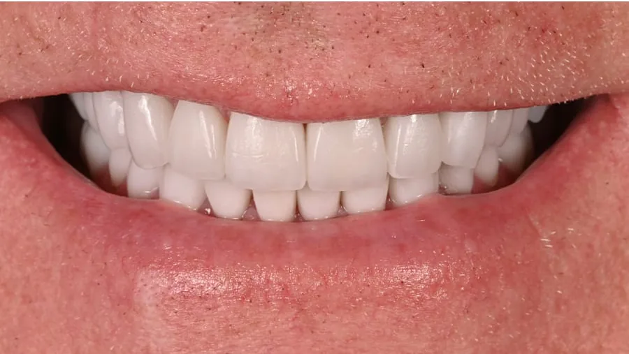 After smile transformation with porcelain restorations, case 24 — Tillinger Dental, Miami Beach