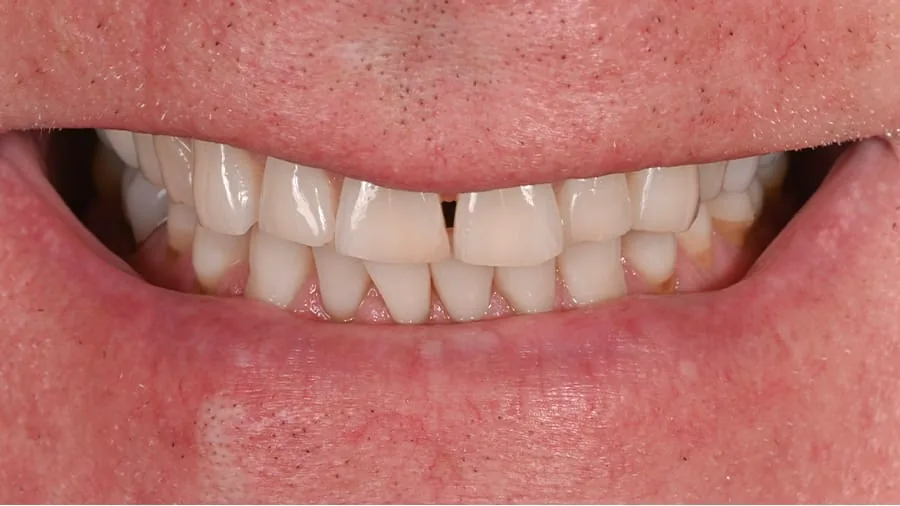 Before smile transformation, case 24 — Tillinger Dental, Miami Beach