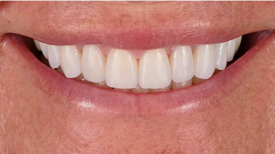 After smile transformation with porcelain restorations, case 27 — Tillinger Dental, Miami Beach