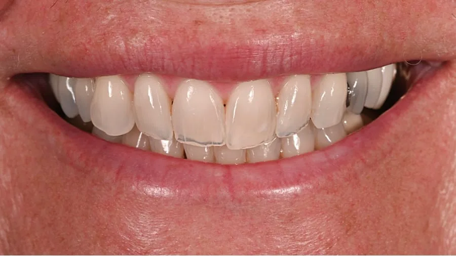 Before smile transformation, case 27 — Tillinger Dental, Miami Beach