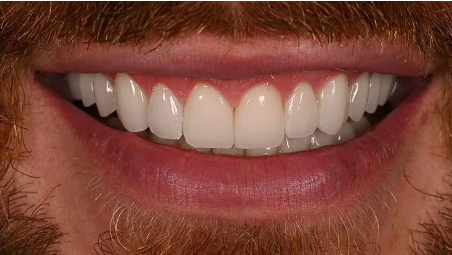 After smile transformation with porcelain restorations, case 28 — Tillinger Dental, Miami Beach