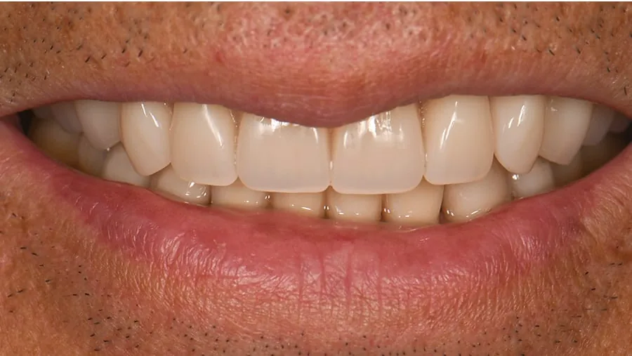 After smile transformation with porcelain restorations, case 29 — Tillinger Dental, Miami Beach