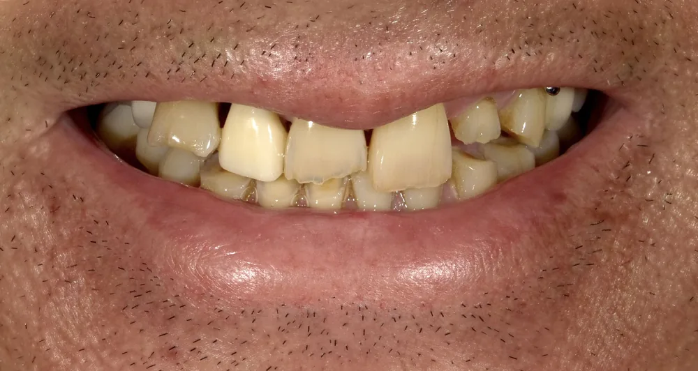 Before smile transformation, case 29 — Tillinger Dental, Miami Beach