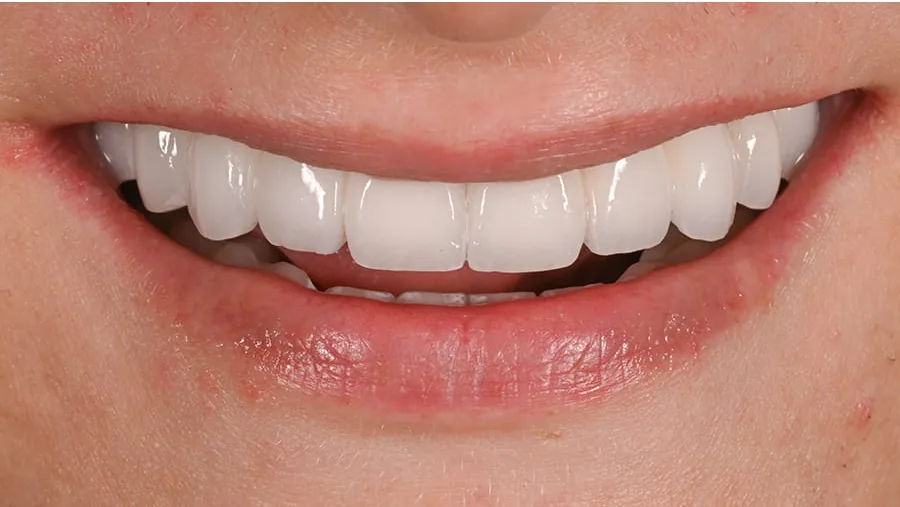 After smile transformation with porcelain restorations, case 30 — Tillinger Dental, Miami Beach