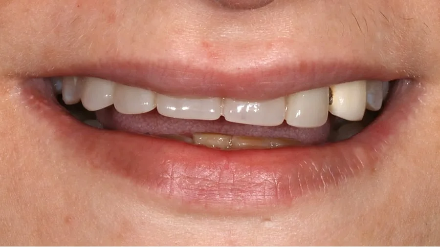 Before smile transformation, case 30 — Tillinger Dental, Miami Beach