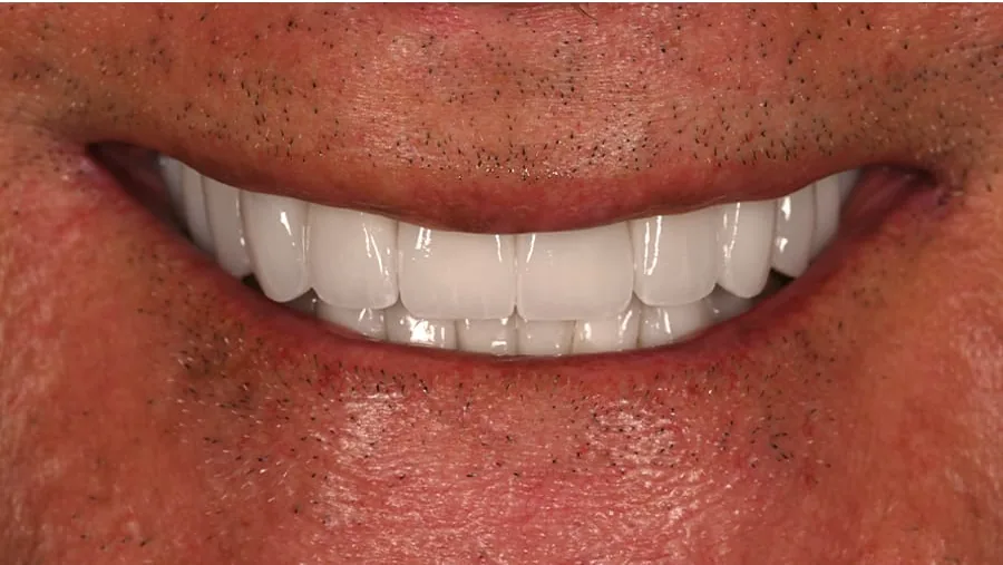 After smile transformation with porcelain restorations, case 31 — Tillinger Dental, Miami Beach