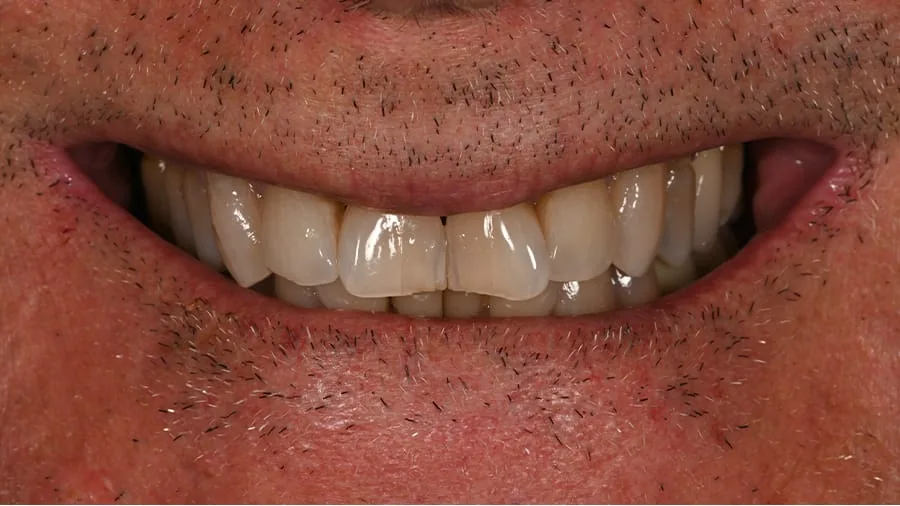 Before smile transformation, case 31 — Tillinger Dental, Miami Beach