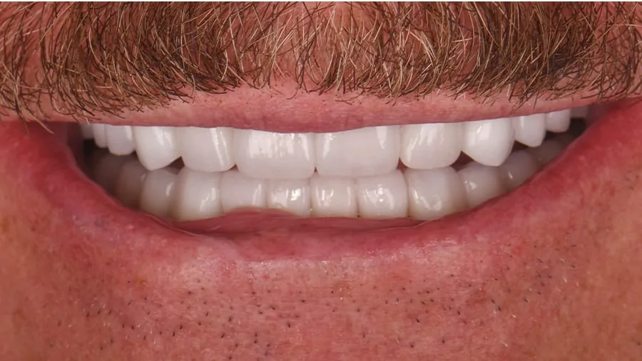 After smile transformation with porcelain restorations, case 33 — Tillinger Dental, Miami Beach